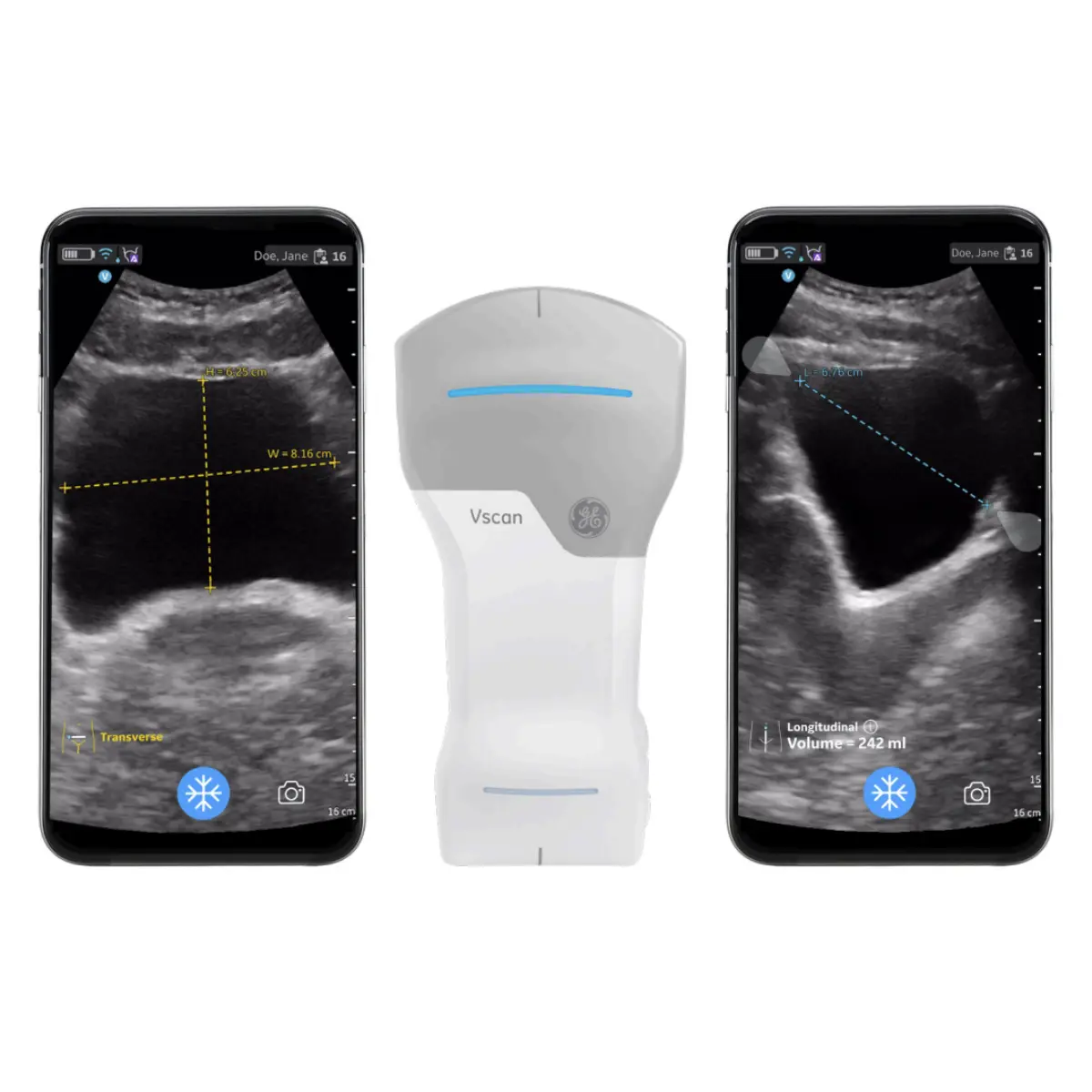 Auto-Bladder-Volume-Upgrade für VScan Air CL Auto-Bladder-Volume-Upgrade für VScan Air CL