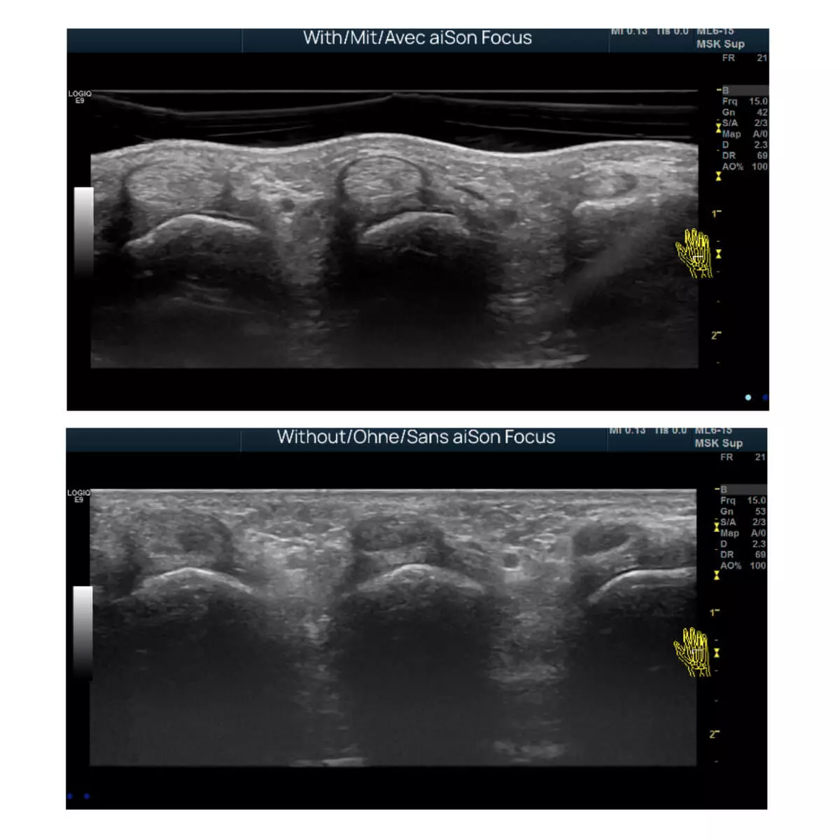  aiSon FOCUS Gelpads für Ultraschallsonden