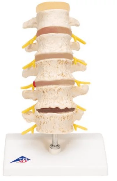  Modell Bandscheibenvorfall