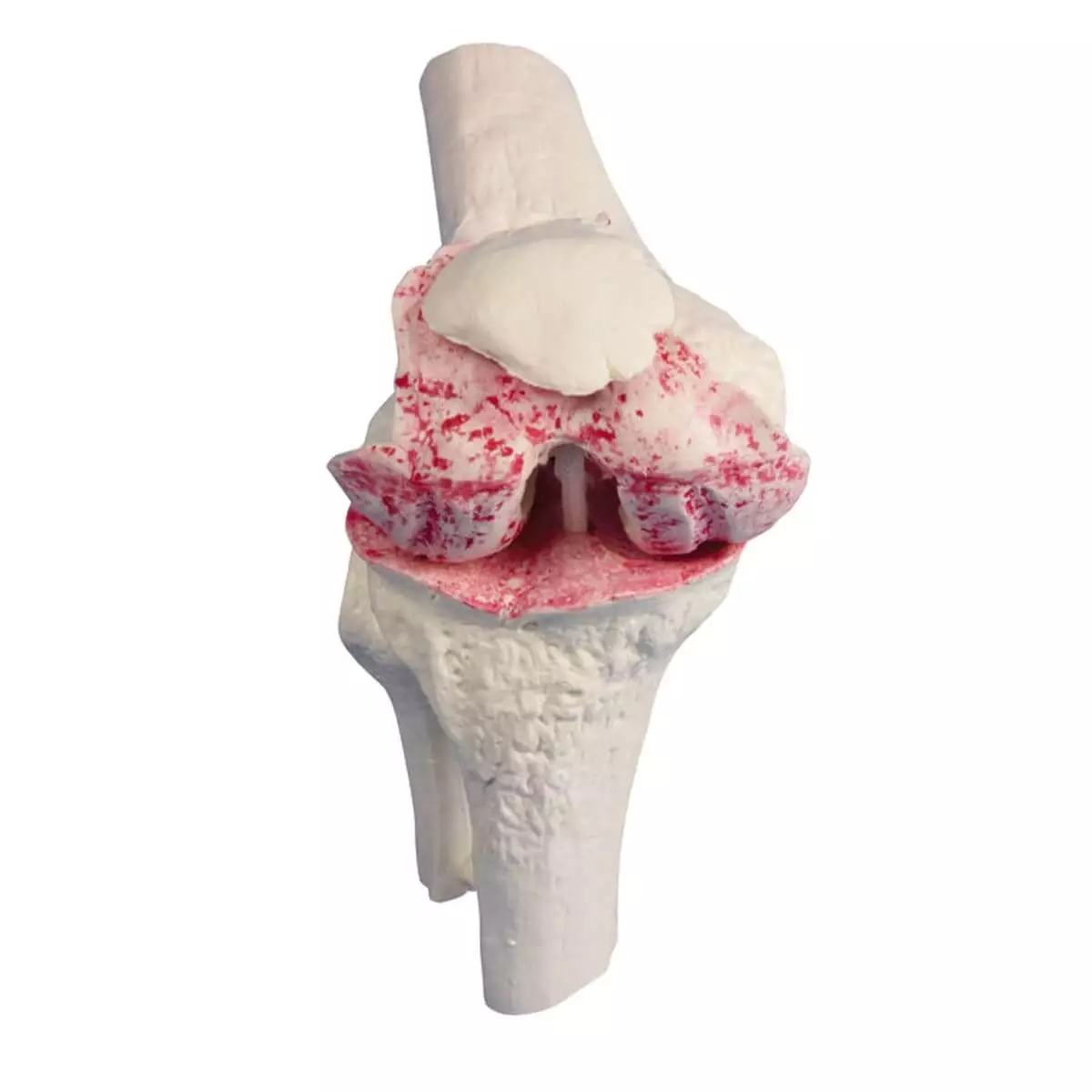  Knie-Implantat-Modell