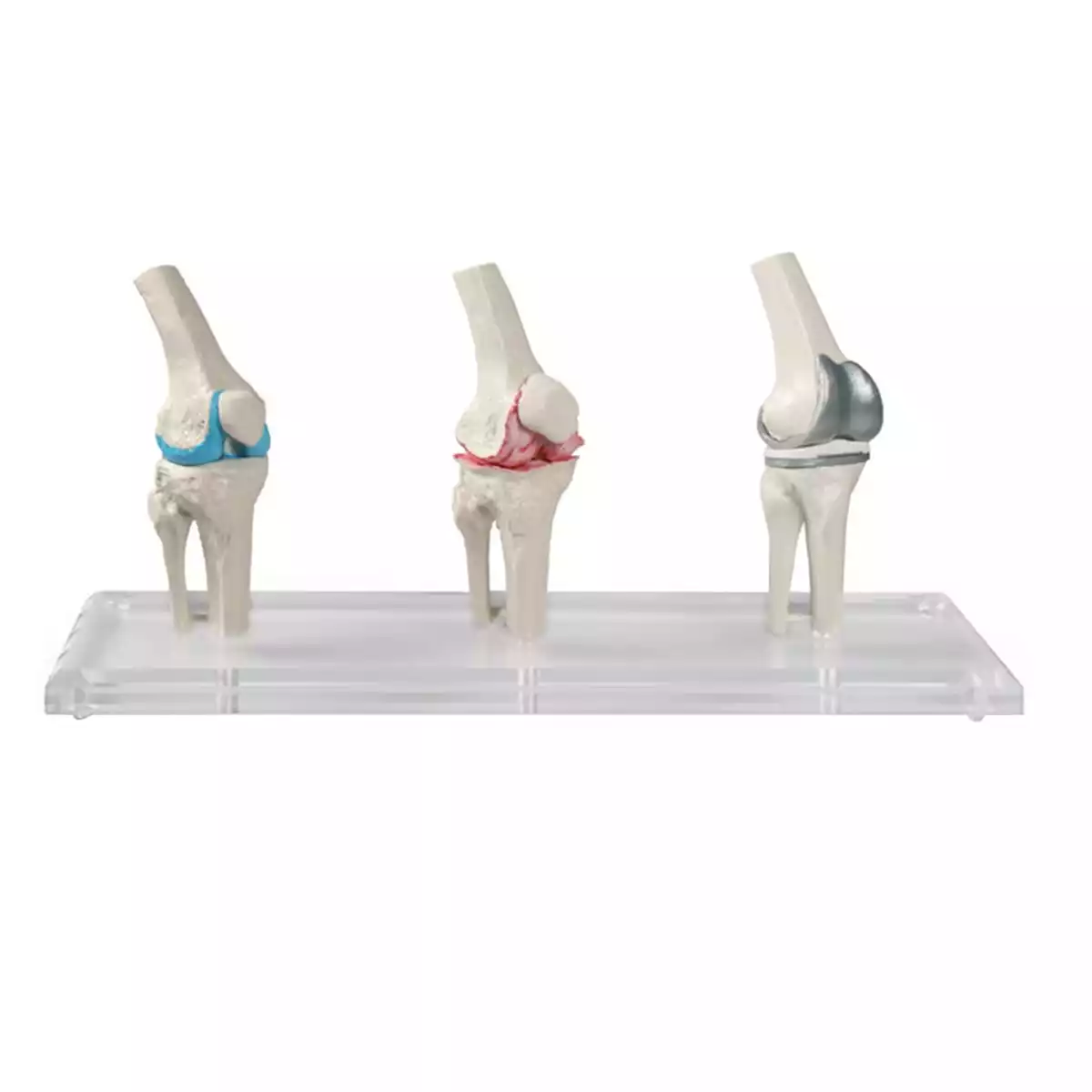 Knie-Implantat-Modell