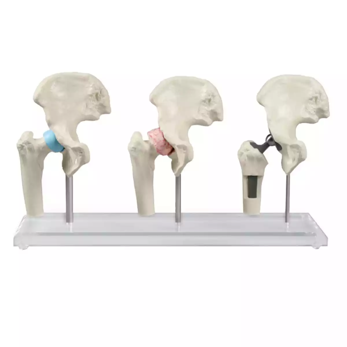  Hüft-Implantat-Modell